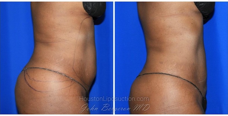 Liposuction before and after