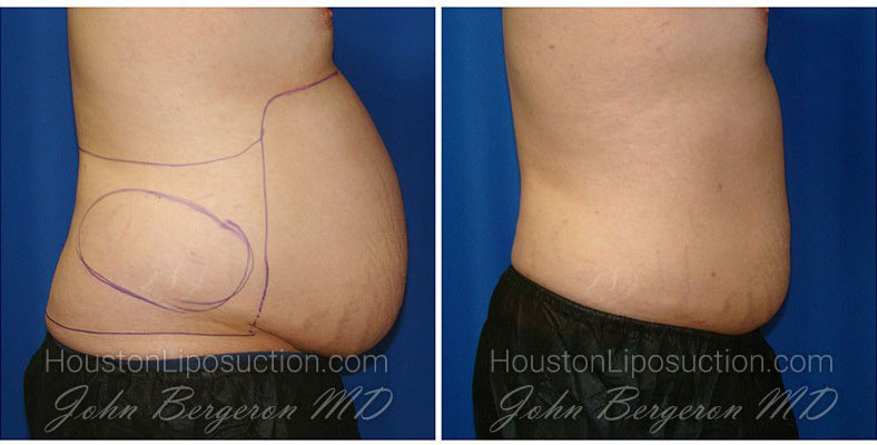 Liposuction before and after