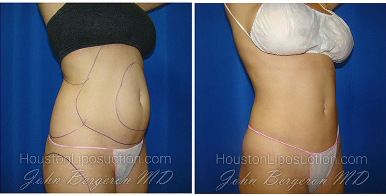 Liposuction before and after