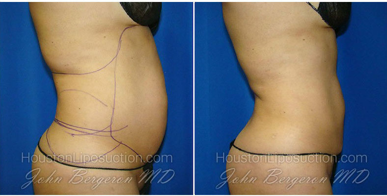 before and after liposuction