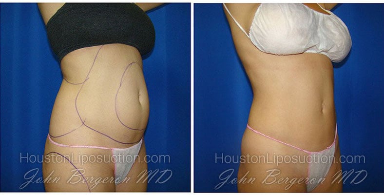 before and after liposuction