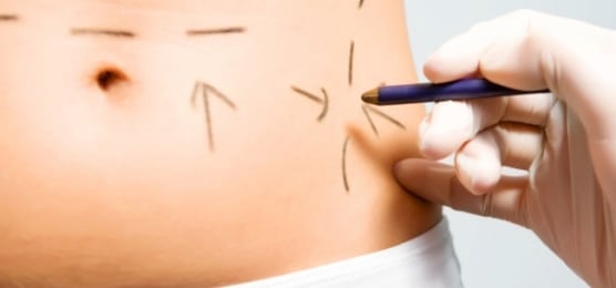 Liposuction outline