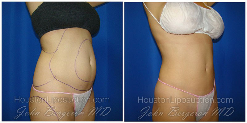 Abdomen