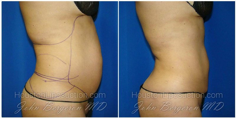 Abdomen