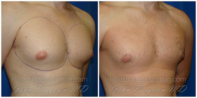 Male Chest