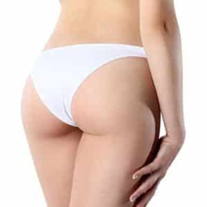 Buttocks liposuction contouring result