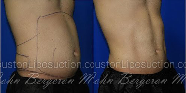 Liposuction for Men