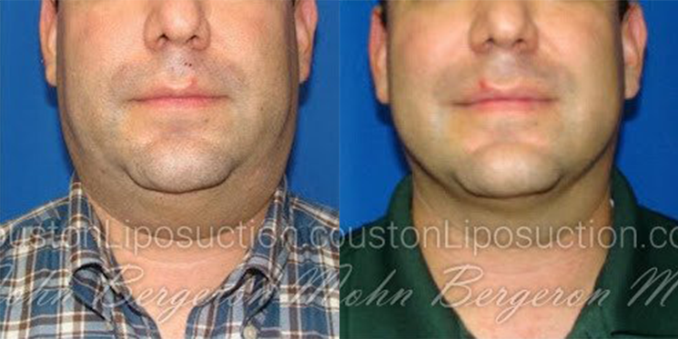 Liposuction for Men