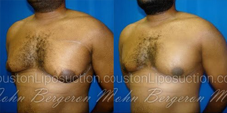 Liposuction for Men
