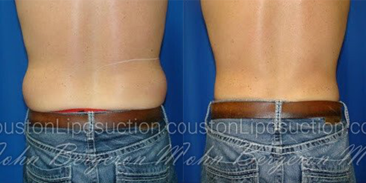 Liposuction for Men