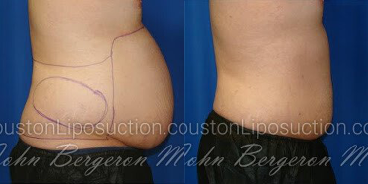 Liposuction for Men
