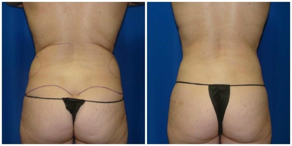 Liposuction Before and After Results