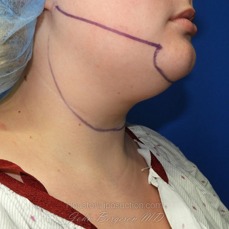 How to Prepare for Liposuction