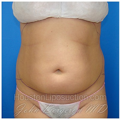 Liposuction before photo