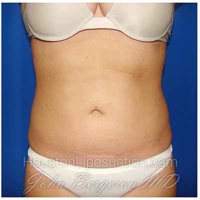 Liposuction after photo