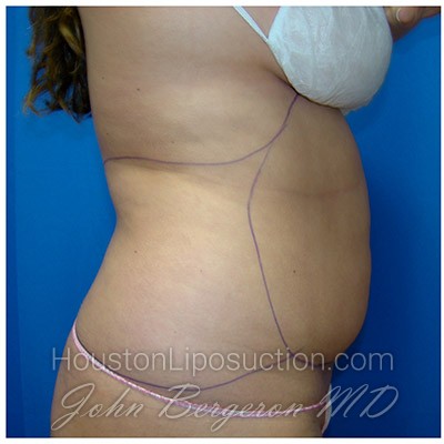 Liposuction before photo