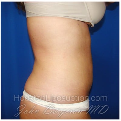Liposuction after photo