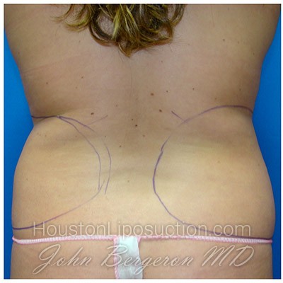 Liposuction before photo