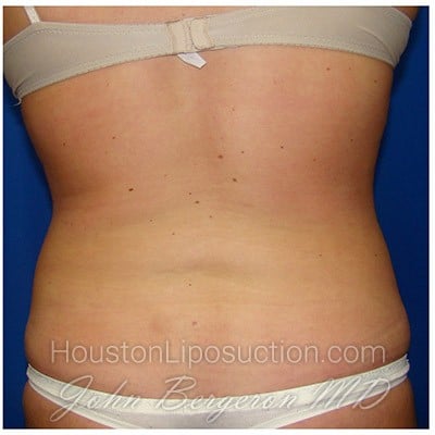 Liposuction after photo