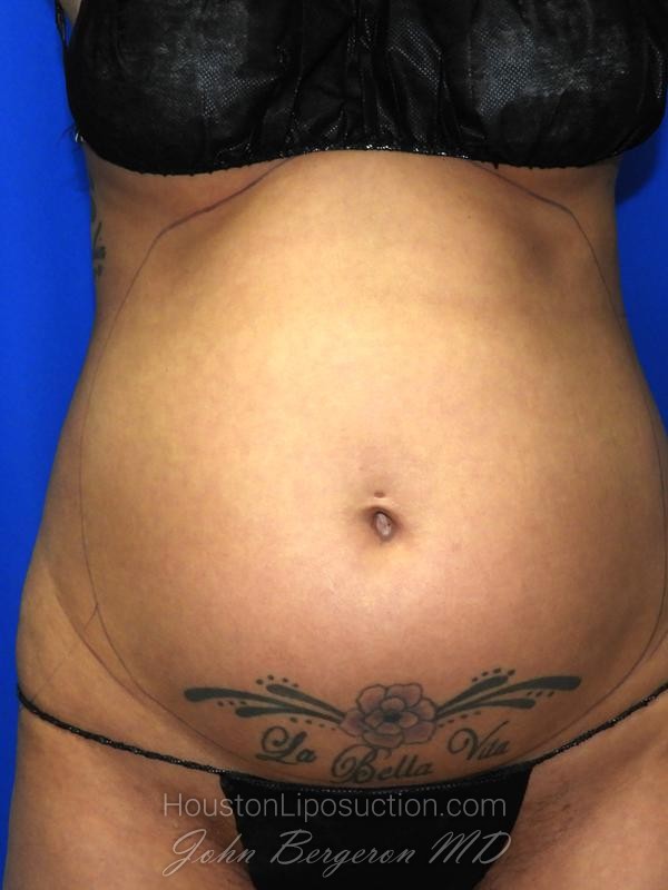 Liposuction before photo
