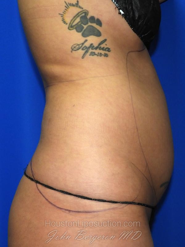 Liposuction before photo