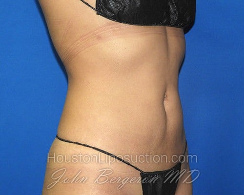 Liposuction after photo
