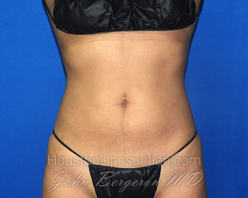Liposuction after photo
