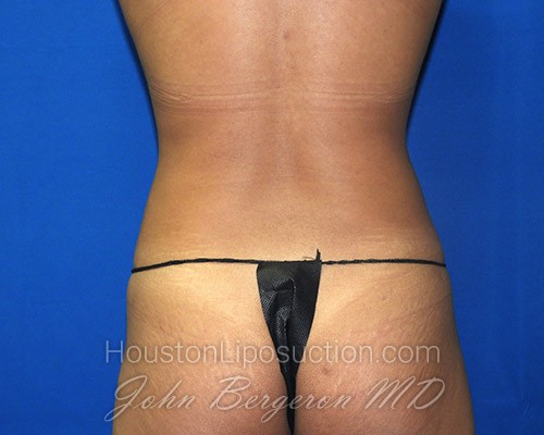 Liposuction after photo