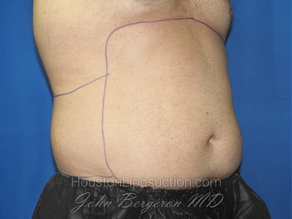 Liposuction before photo