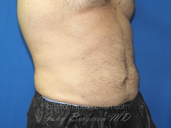 Liposuction after photo