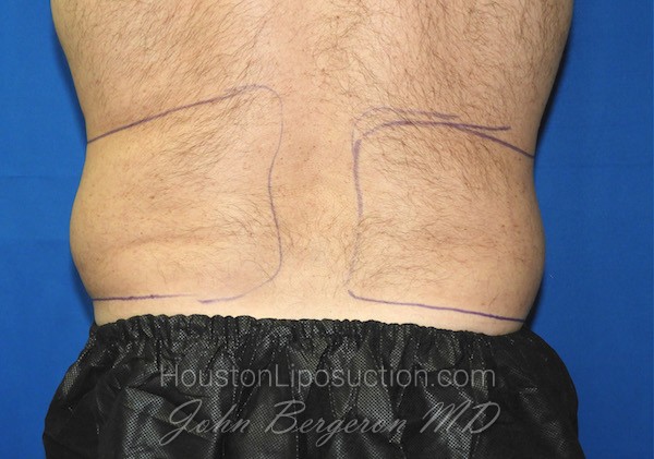 Liposuction before photo
