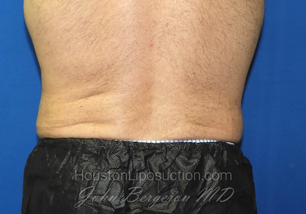 Liposuction after photo