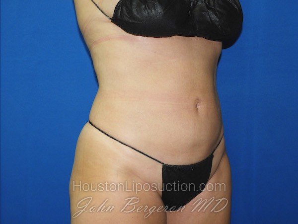 Liposuction after photo