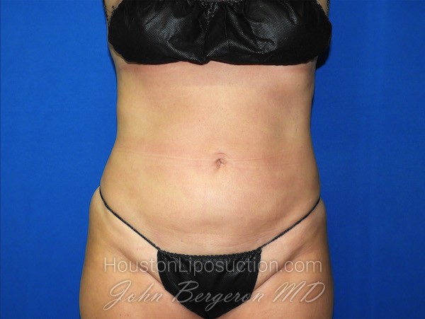 Liposuction after photo