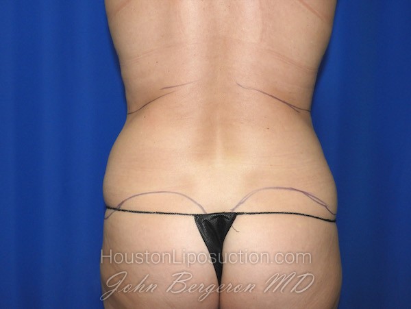 Liposuction before photo