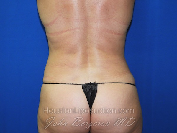 Liposuction after photo