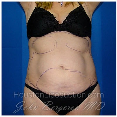 Liposuction before photo