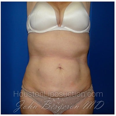 Liposuction after photo