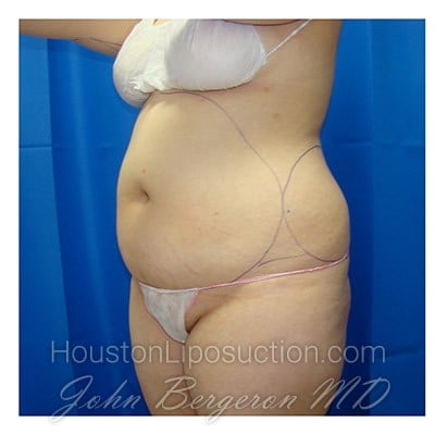 Liposuction before photo