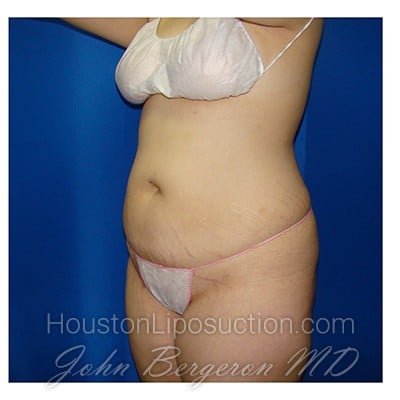 Liposuction after photo