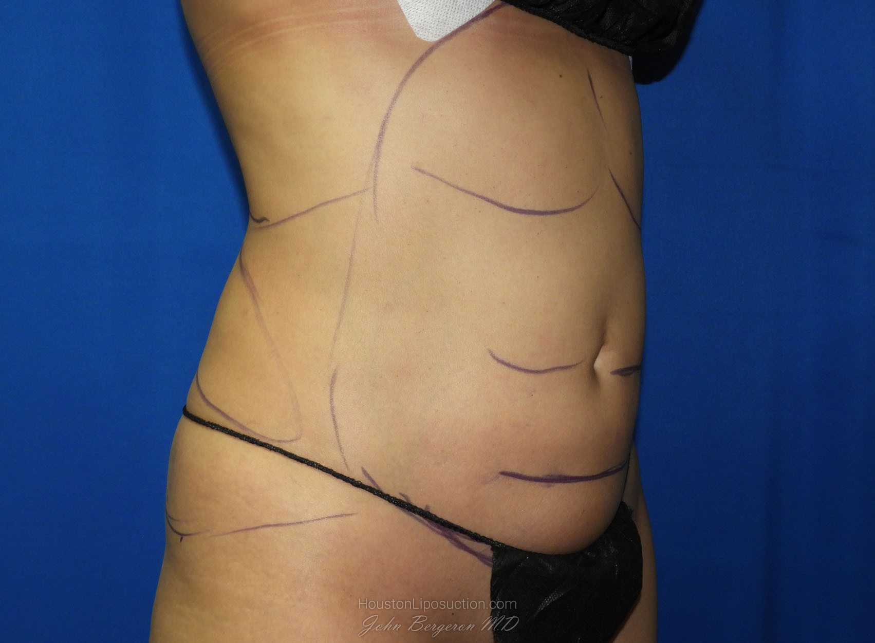 Liposuction before photo