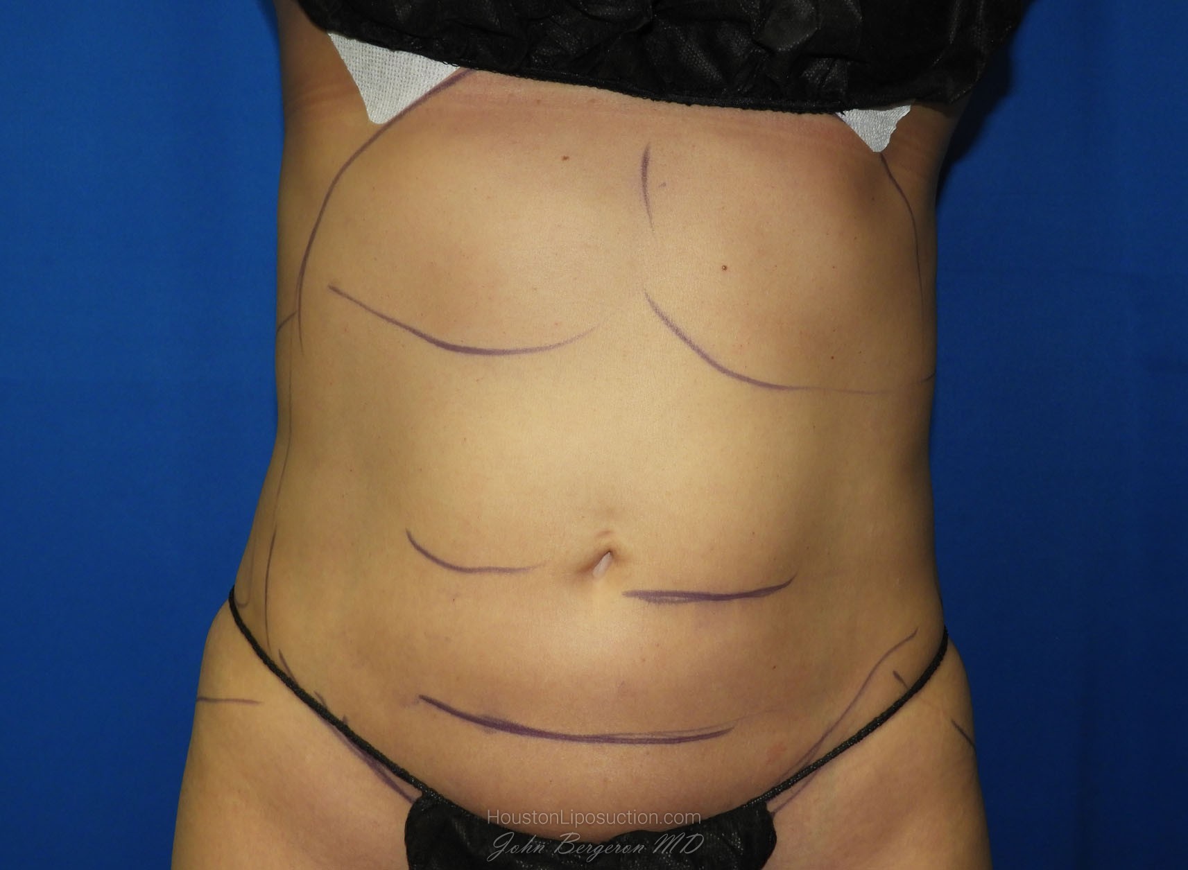 Liposuction before photo