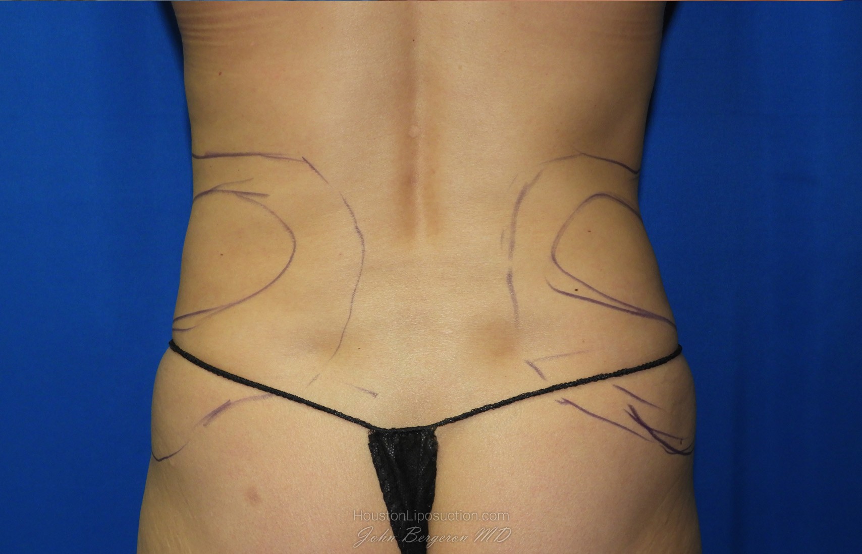 Liposuction before photo