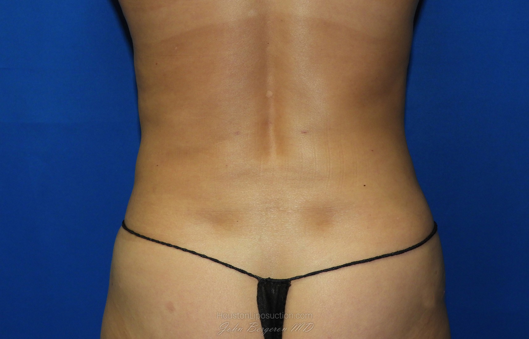 Liposuction after photo
