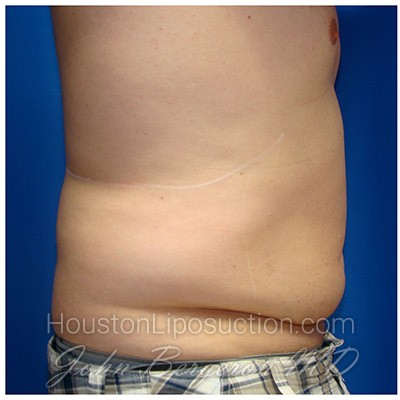Liposuction before photo