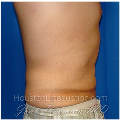 Liposuction after photo