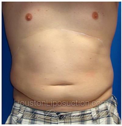 Liposuction before photo