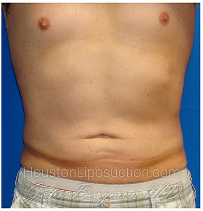 Liposuction after photo