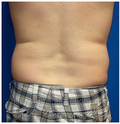 Liposuction before photo