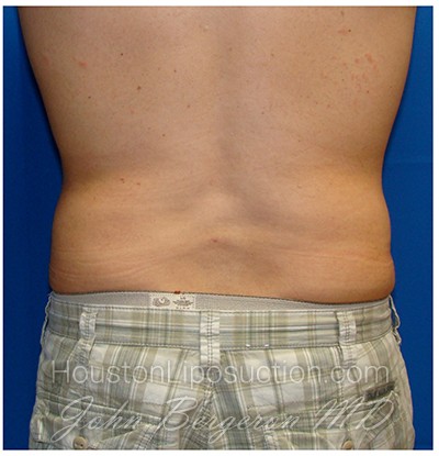 Liposuction after photo